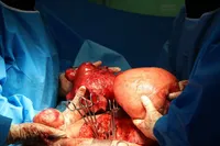 خارج کردن یک توده ۴ کیلویی مشکوک از شکم یک بانوی ۴۶ ساله بابلی