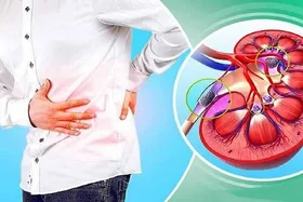 اولین نشانه&zwnj;های ابتلا به سنگ کلیه | برای جلوگیری از ابتلا به سنگ کلیه این کار ساده را انجام دهید