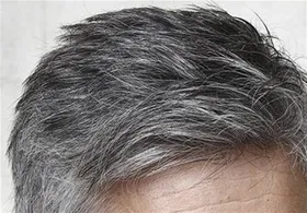 دلایل سفید شدن مو&zwnj; در سنین جوانی
