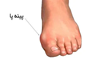 پینه بستن پا از نشانه&zwnj;های کف پای صاف است