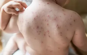 به&zwnj;صدا&zwnj;درآمدن زنگ&zwnj;خطر شیوع آبله&zwnj;مرغان، سرخک و آنفلوانزا در خراسان&zwnj;رضوی