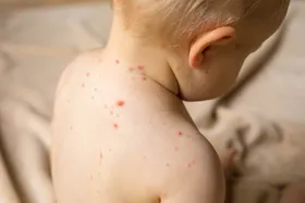 افزایش موارد آبله مرغان و سرخک در مشهد | هشدار دانشگاه علوم پزشکی مشهد به خانواده&zwnj;ها برای جلوگیری از سرایت بیشتر
