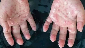 بررسی موارد مشکوک آبله میمونی در ۱۲ قطب دانشگاهی| بیماری هنوز به ایران نرسیده است
