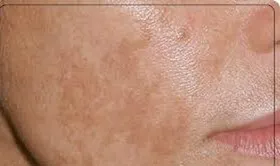 چگونه از ایجاد لکه های پوستی در دوران بارداری پیشگیری کنیم؟
