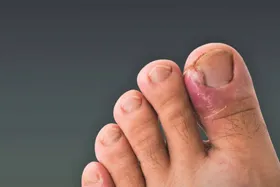 چگونه از فرورفتگی ناخن پیشگیری کنیم؟ +روش&zwnj;های درمان آن