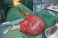 خارج کردن یک کیست ۳ کیلویی از شکم یک خانم ۲۳ ساله تربت جامی