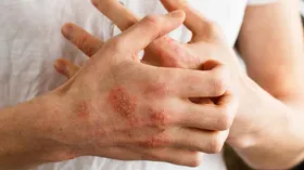 آنتی&zwnj;هیستامین&zwnj;ها را خودسرانه مصرف نکنید
