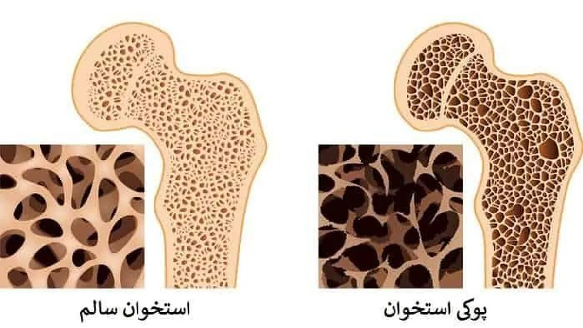 یائسگی زودرس، عامل مهم در ابتلای زنان به پوکی استخوان