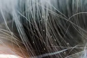 رعایت&zwnj;نکردن مراقبت&zwnj;های بهداشتی، می&zwnj;تواند سبب تخم گذاری شپش بر روی مو و پوست بدن شود