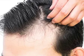 این غذا&zwnj;ها را نخورید تا ریزش مو نگیرید