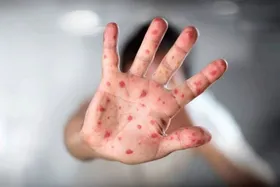 سازمان ملل در رابطه با مرگ&zwnj;ومیر کودکان افغانستانی براثر ابتلا به سرخک هشدار داد