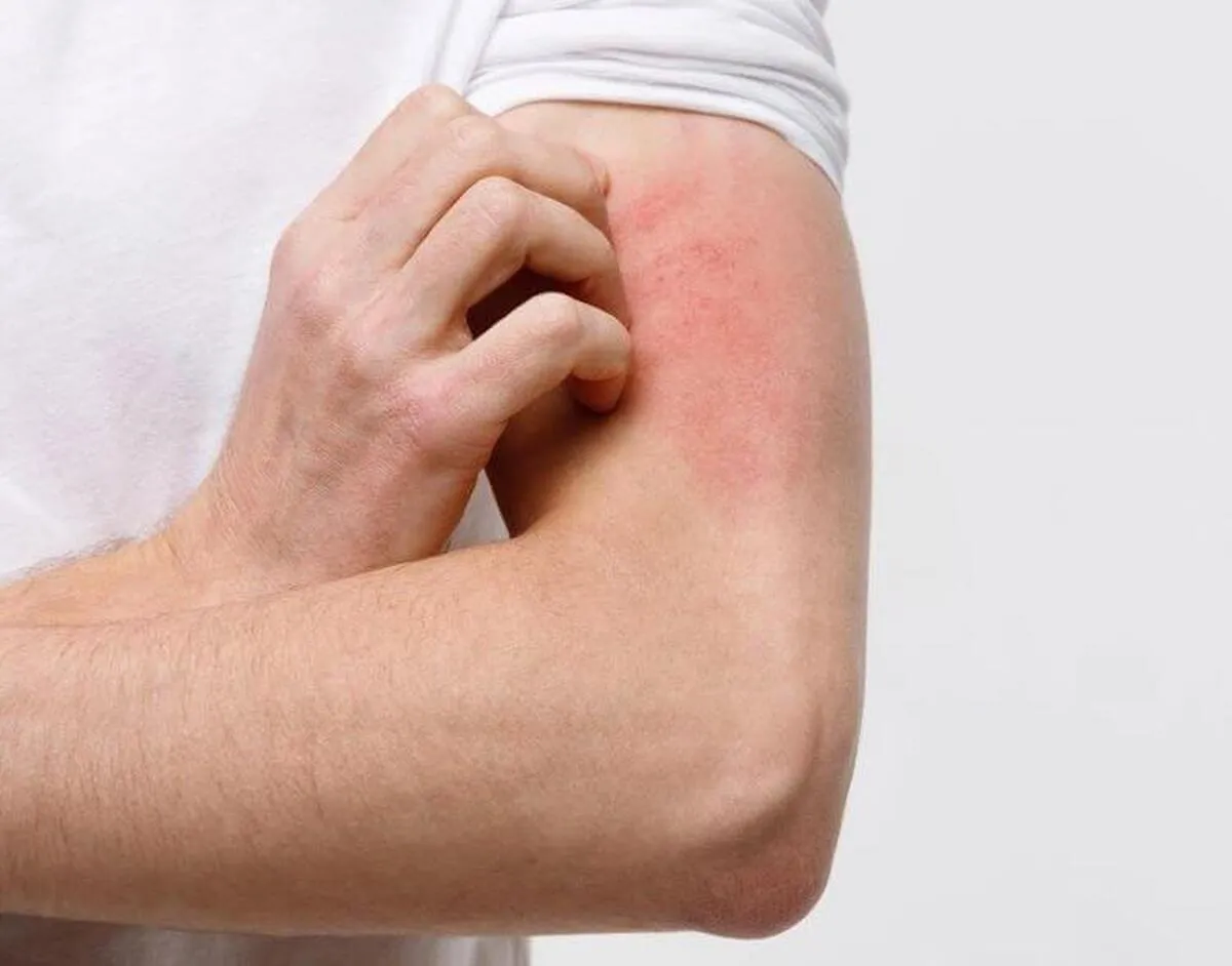 چگونه از شر خارش و التهاب در فصل بهار رها شویم؟