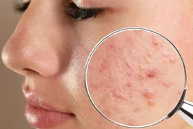 همه چیز درباره آکنه یا جوش&zwnj;های پوستی و راه&zwnj;های درمان آن | چاله&zwnj;چوله&zwnj;های پوستی