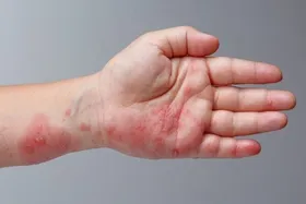 بیماری زونا چیست؟ | چه کسانی بیشتر در معرض ابتلا به بیماری زونا هستند؟