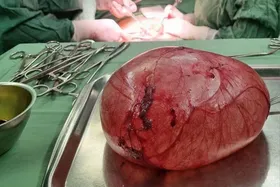 توده ۲ کیلو و ۲۰۰ گرمی از شکم بانوی ۸۶ ساله همدانی از رطیق انجام عمل جراحی خارج شد
