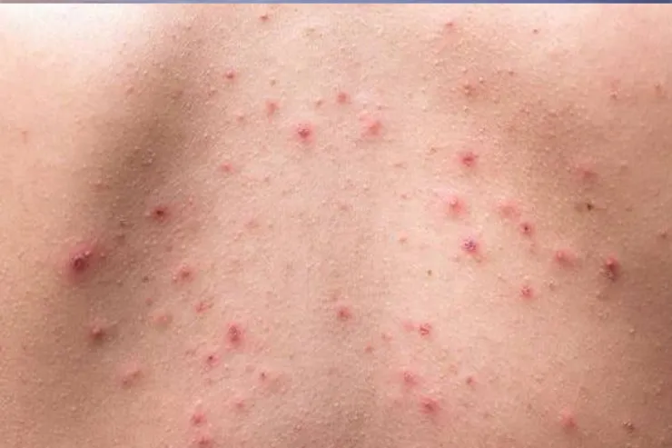 چند راه حل ساده برای مقابله با جوش های بدن