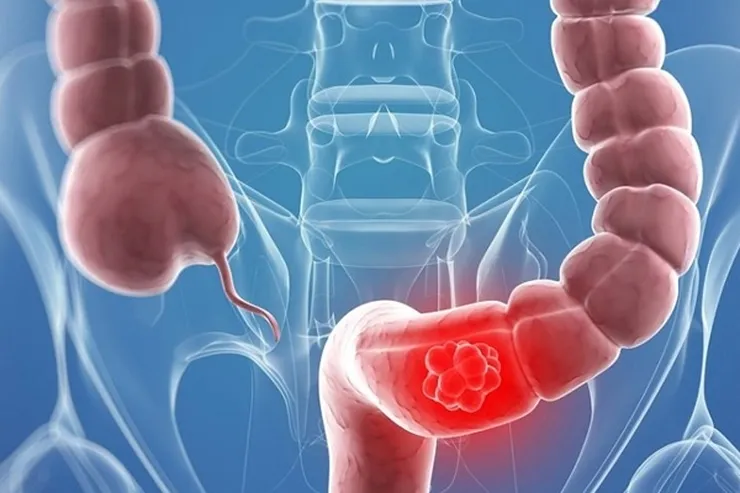 اینفوگرافی | علائم سرطان روده