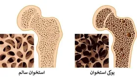 یائسگی زودرس، عامل مهم در ابتلای زنان به پوکی استخوان