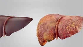 علائم هشدار دهنده کبد چرب را بیشتر بشناسید