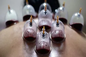 آیا حجامت باعث لاغری و افزایش قد می&zwnj;شود؟