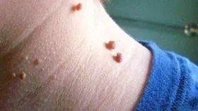 زگیل&zwnj;ها عمدتا سرطانی نیستند