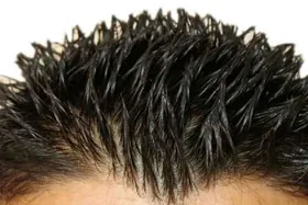 علل چرب شدن موی سر + راهکار&zwnj;های درمان آن