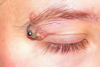 حلقه‌های مرگ‌بار زیبایی، خطر ابتلا به بیماری‌های عفونی و هپاتیت را به همراه دارد