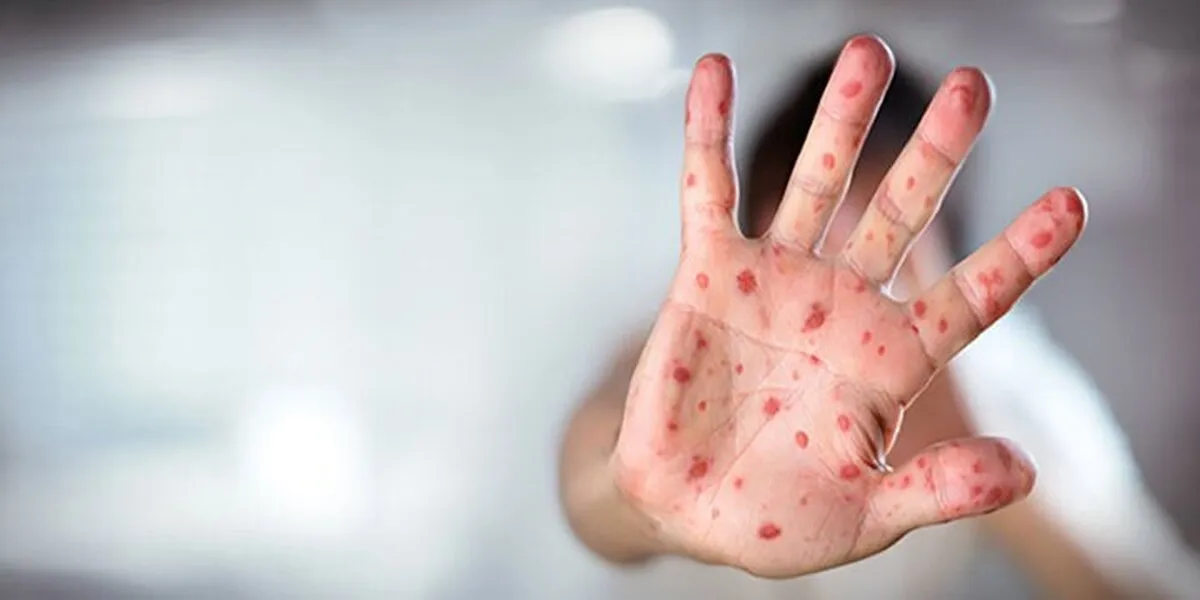 ۵۰۰ کودک بنگلادشی بر اثر سرخک جان باختند