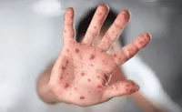 دومین مورد آبله میمونی جهش‌یافته در خارج از آفریقا تایید شد