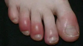 ۵ عارضه پوستی که نشانه ابتلا به کروناست