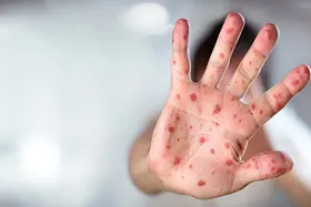 معاون وزیر بهداشت: شیوع &laquo;سرخک&raquo; در عراق| زائران اربعین نسبت به کامل کردن سابقه واکسیناسیون کودکانشان اقدام کنند