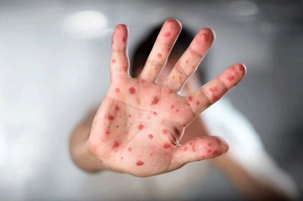 سازمان ملل در رابطه با مرگ‌ومیر کودکان افغانستانی براثر ابتلا به سرخک هشدار داد