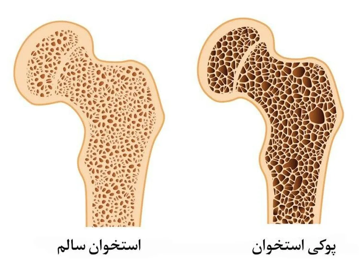 درباره استئوپروز چه می‌دانید؟ | شیوع نوعی پوکی استخوان در کودکان