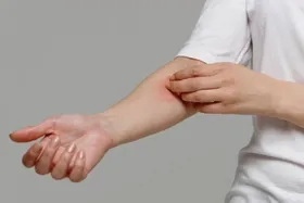 اگزما چیست؟  + روش&zwnj;های ساده درمان اگزما و خارش پوست