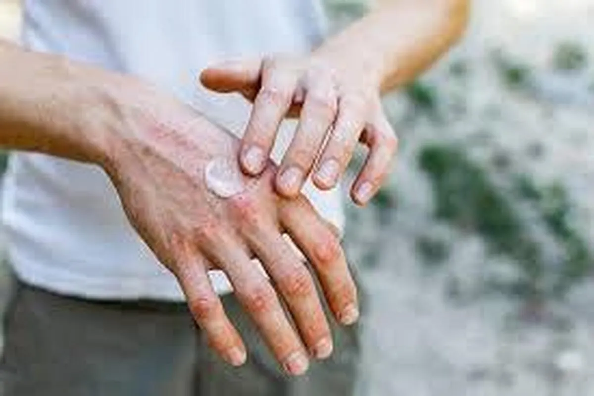 هوای سرد چه آسیب‌هایی به پوست می‌زند؟