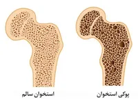 انجام تمرینات انفجاری؛ راهکاری مناسب برای پیشگیری از پوکی استخوان