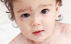 کاهش موارد ابتلا به سرخک در مشهد نسبت&zwnj;به سال گذشته