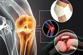 آرتروز، دردی بی&zwnj;&shy;امان و بی&zwnj;پایان