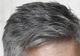دلایل سفید شدن مو&zwnj; در سنین جوانی