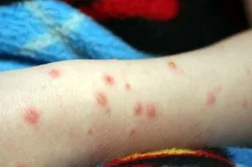 شناسایی ۱۱۵ مورد جدید ابتلا به تب مالت در نیشابور