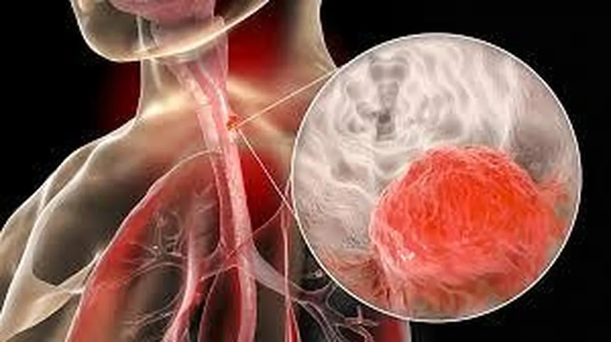 گیرگردن غذا از علائم هشداردهنده بیماری سرطان مری است