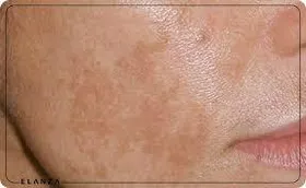 چگونه از ایجاد لکه های پوستی در دوران بارداری پیشگیری کنیم؟
