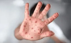 دومین مورد آبله میمونی جهش&zwnj;یافته در خارج از آفریقا تایید شد