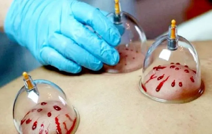 درباره تاثیر حجامت بر کاهش غلظت خون در بیماران قلبی و عروقی