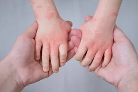 هیچ راهی برای جلوگیری از اگزمای دوران کودکی وجود ندارد