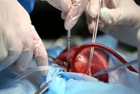 ویدئو| جراحی و عمل پیوند کلیه