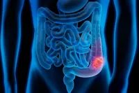 چگونه ریسک ابتلا به سرطان روده را کاهش دهیم؟