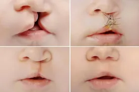 از هر ۱۰۰۰ تولد ۴ نوزاد با شکاف لب متولد می&zwnj;شوند