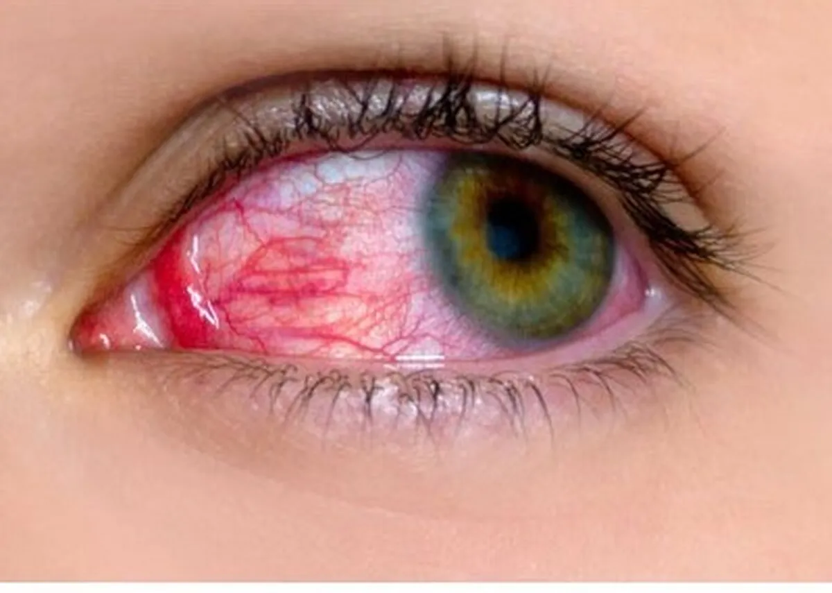 هشدار چشم‌پزشک درباره لوازم آرایشی غیراستاندارد | سلامت قرنیه را به خطر نیندازید
