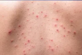 چند راه حل ساده برای مقابله با جوش های بدن